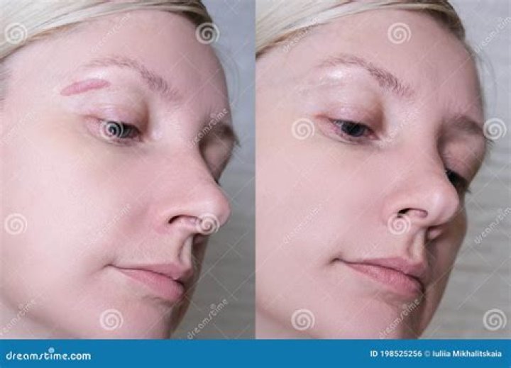 Before And After Accident And Eye Video