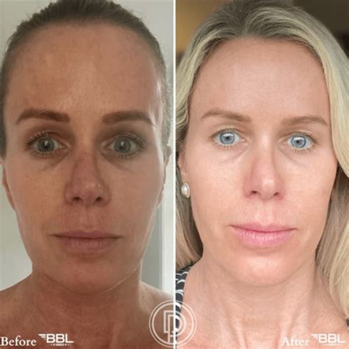 Does Ice Spice Have A BBL? Before And After Photos