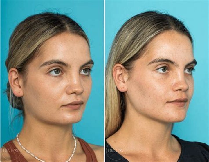 Has She Done Jaw Surgery And Botox ·