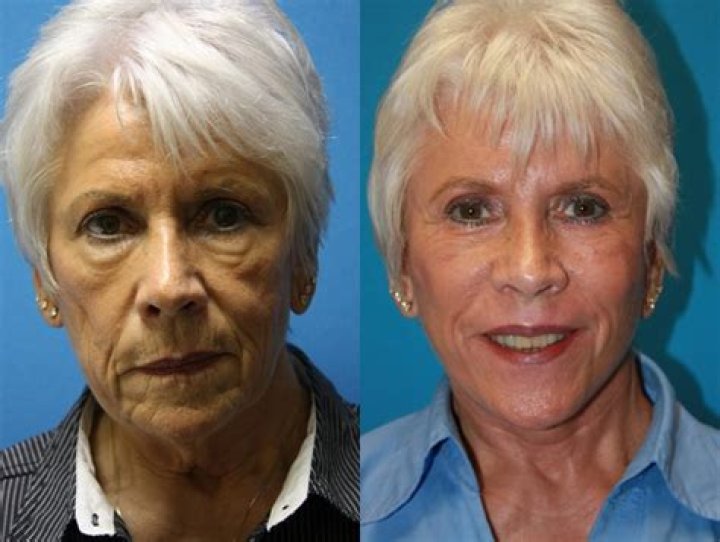 Jelai Andres Before and After Plastic Surgery, Old Photos Age And Wikipedia