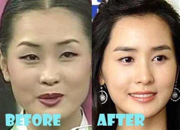 Lee Da Hee Plastic Surgery Before And After: What Is Wrong?